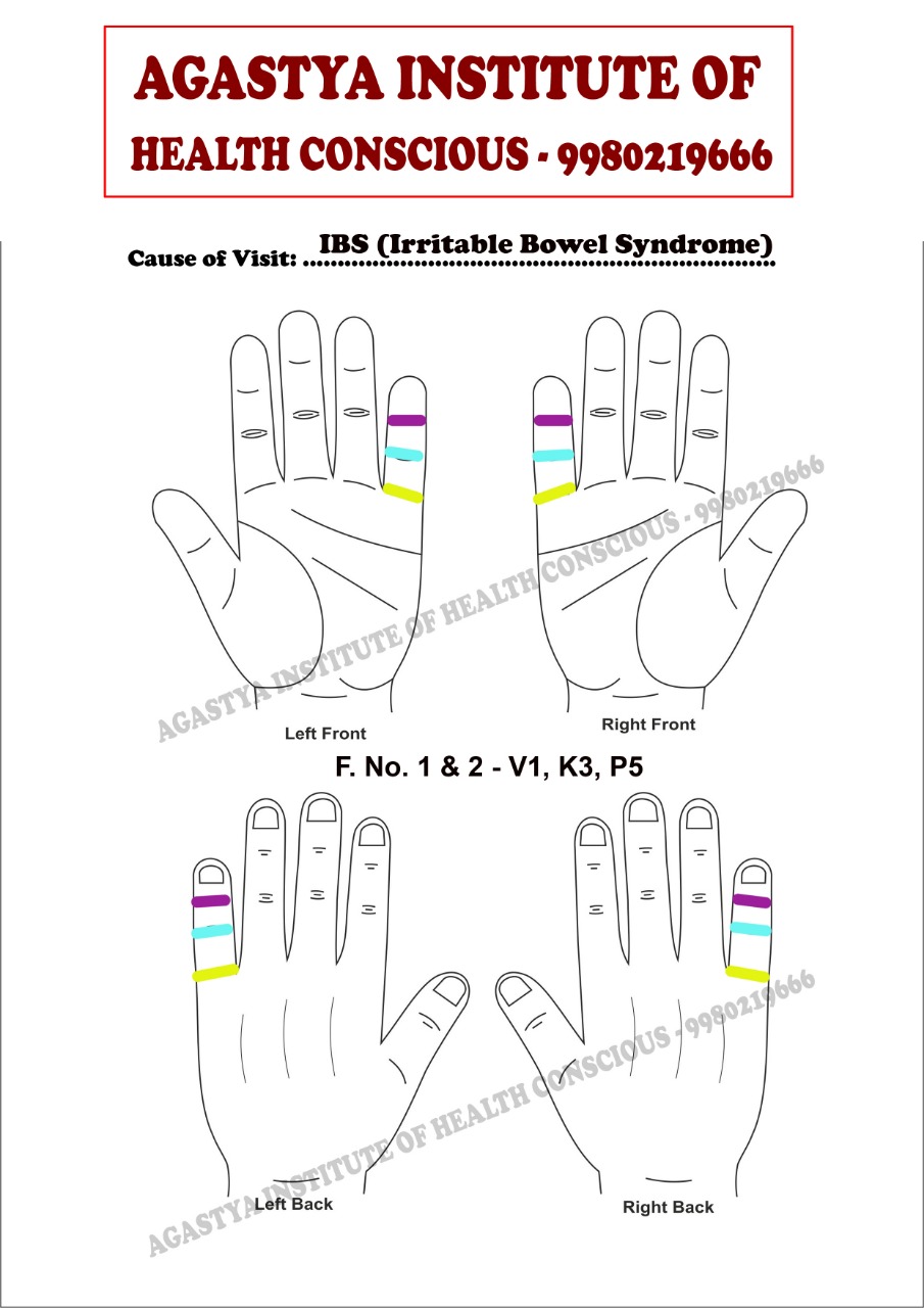 Irritable Bowel Syndrome